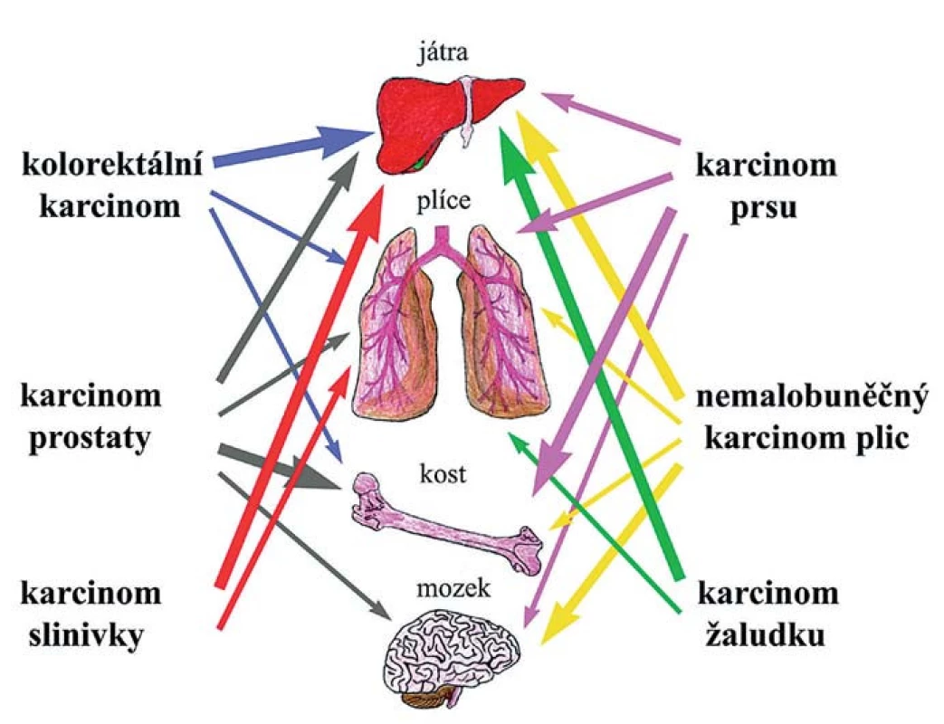 Tkáňový tropizmus.
Různé typy karcinomů a cílové tkáně, do nichž nejčastěji metastazují. Frekvence metastáz je znázorněna sílou jednotlivých šipek.