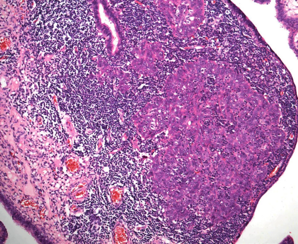 Drobné ložisko průměru 0,6 mm nízce diferencovaného (high-grade) serózního adenokarcinomu ve sliznici fimbriální části tuby jako náhodný mikroskopický nález u 40leté ženy se zárodečnou mutací genu BRCA1. V okolí nádorového ložiska je intenzivní zánětlivý infiltrát (hematoxylin-eozin, původní zvětšení 100×)