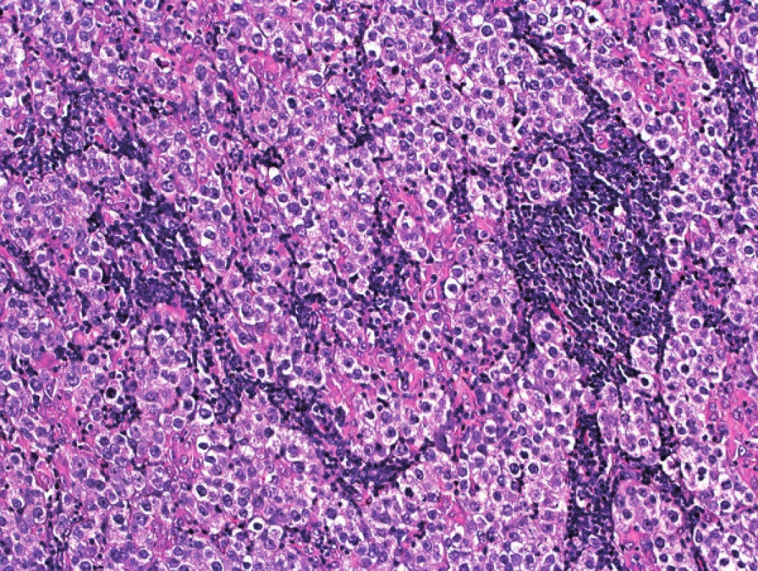 Histologický obraz nádoru z retroperitonea svedčil pre metastázu seminómu do lymfatickej uzliny, s typickými zhlukmi svetlých atypických buniek s jasnými bunkovými membránami, oddelenými fibrovaskulárnymi septami s lymfoidnými infiltrátmi (zväčšenie 100×; farbenie hematoxylín – eozín)
Fig. 4. Histologically, retroperitoneal tumour represented a metastasis of seminoma into lymph node and was composed of clusters of atypical large cells with clear cytoplasm and distinct cell membranes, separated by fibrovascular septa with lymphoid infiltrates (magnification 100×; hematoxylin – eosin staining)