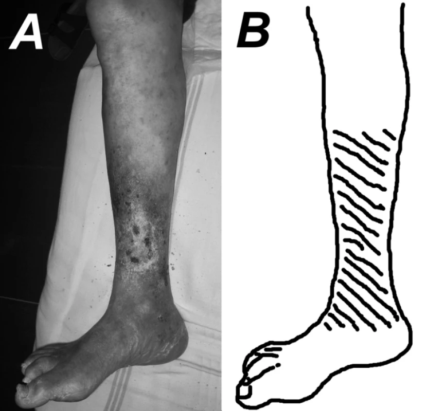 A – typická lokalizácia a tvar VU (fotografia pravej dolnej končatiny 79-ročného muža s 12-ročnou
anamnézou VU DK pre posttrombotický syndróm),
B – šráfovanie vyznačuje typickú lokalizáciu VU