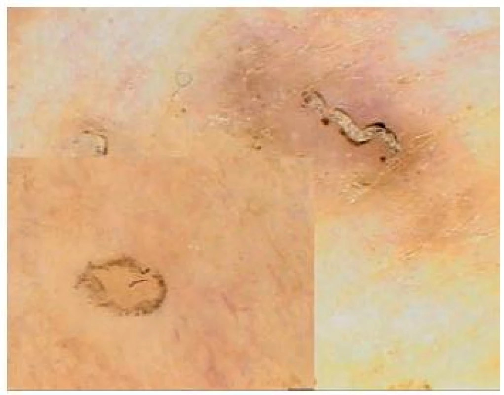 Scabies
Na větším obrázku je chodbička s parazitem na konci (fenomén rogala nebo tryskového letadla), ve výřezu průsvitné tělo zákožky při použití většího zvětšení.