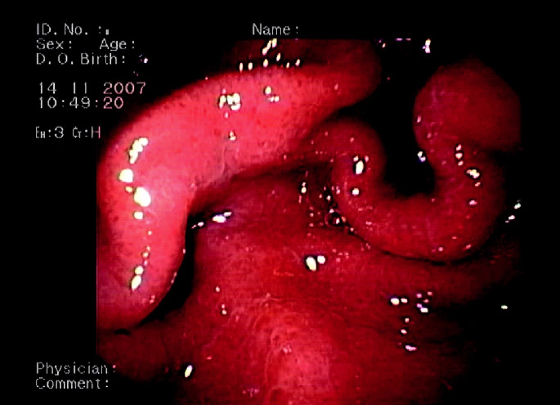 Endoskopický obraz portální hypertenzní gastropatie (mozaikovitý vzhled žaludeční sliznice s oj. hemorhagiemi).