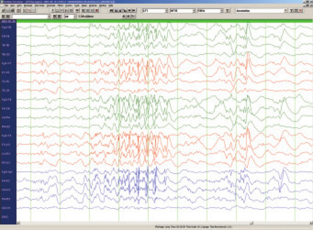 Lennox-Gastautův syndrom (7let) – rychlé rytmické hroty v NREM spánku.
