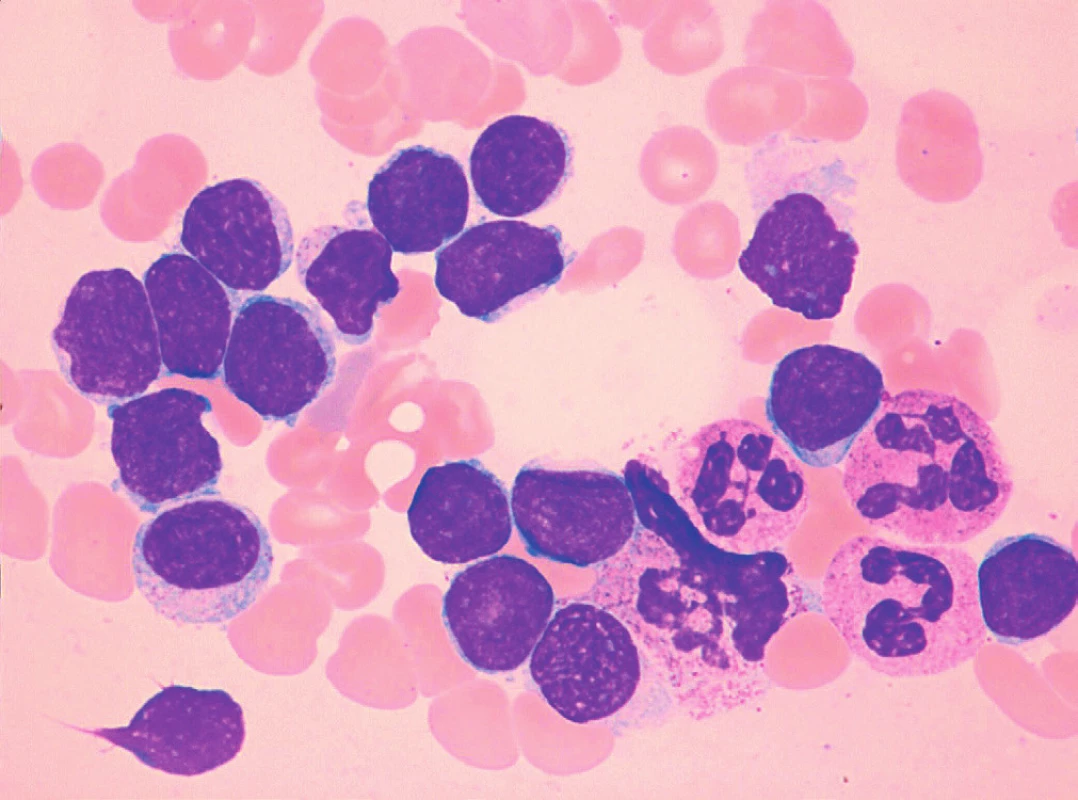 MCL, malobuněčná („CLL-like“) varianta, převaha malých zralých lymfocytů, nátěr kostní dřeně, barvení May-Grünwald, Giemsa-Romanowski, světelná mikroskopie, zvětšení 1000krát