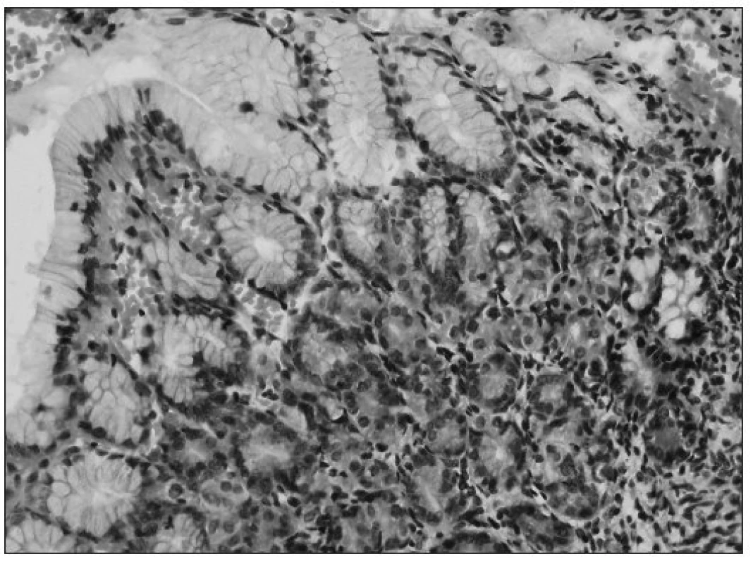 Detailný obrázok na heterotopickú žalúdočnú sliznicu, ktorá je na povrchu krytá charakteristickým foveolárnym epitelom a s nálezom parietálnych buniek v žliazkach (farbenie
hematoxylín-eozín, zväčšenie 400x).
Fig. 3. Detailed picture of heterotopy in stomach mucosa, covered on the surface with
a characteristic foveolar epithelium and a finding of parietal cells in the glands (staining with hematoxylin and eosin, 400-fold magnification).