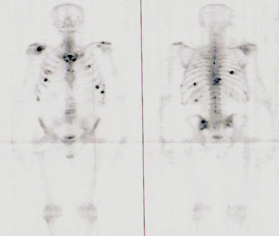 Scintigrafie skeletu s ložisky zvýšené metabolické kostní aktivity ve sternu, žebrech, ramenech, páteři a SI skloubeních