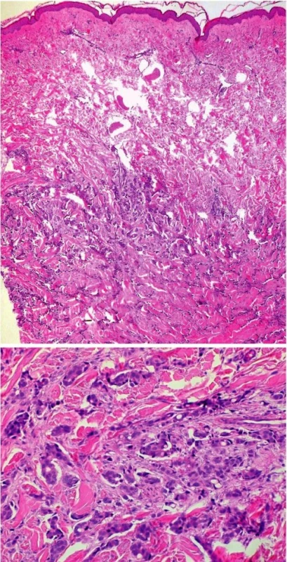 Metastázy karcinomu prsu v koriu (a – přehled, HE, 40x, b – detail, HE, 400x).