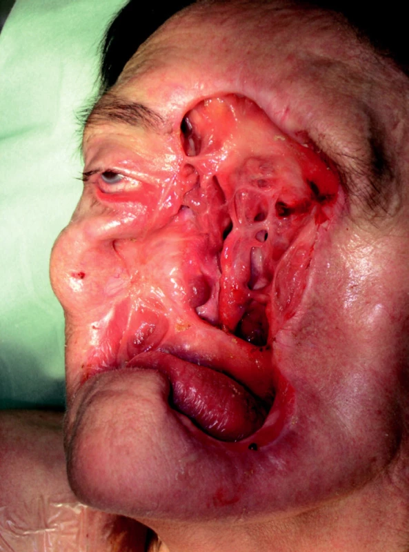 Rozsáhlý defekt obličeje vzniklý po onkologicko-chirurgické fázi terapie.