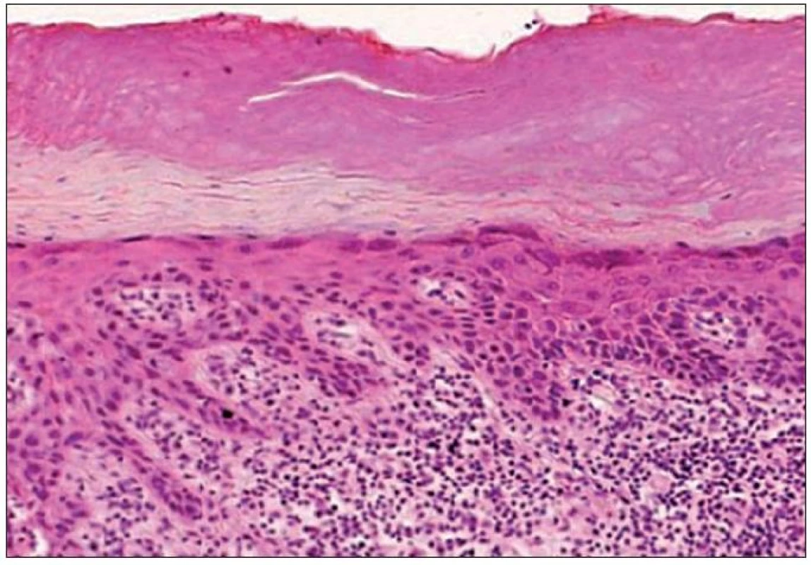 Kombinovaný hypertroficko-atrofický typ AK – nepravidelne hrubá epiderma s atypiami keratinocytov a epiteovými protrúziami do papilárnej časti kória. Na povrchu je výrazná parakeratóza a hyperkeratóza, v kóriu chronická zápalová celulizácia (H&amp;E, 400x).