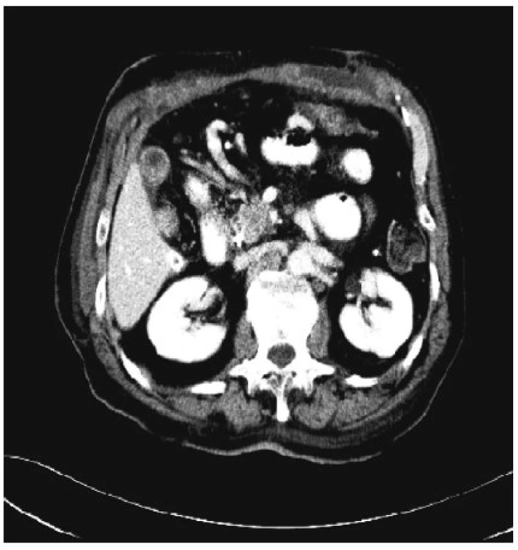 Předoperační CT zobrazující maligní neuroendokrinní tumor těla pankreatu
Fig. 3. Preoperative CT scan depicting a tumor of the pancreatic head