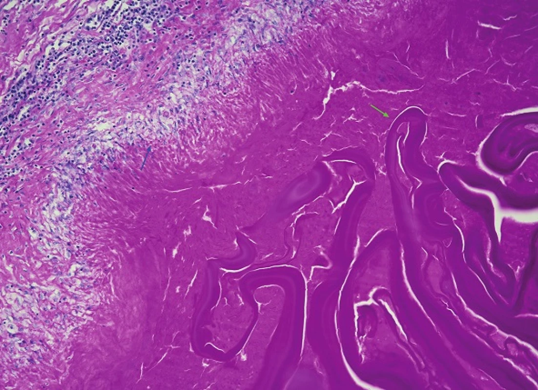 A more detailed view of the wall of one of the liver cysts on higher magnification Its outer layer consists of granulation tissue formed by palisading epithelioid macrophages (blue arrow) and a peripheral predominantly lymphocytic border. Inside, detached fragments of the intermediate layer which has the characteristics of an avascular and eosinophilic laminar membrane can be seen (green arrow) (H&amp;E, 200x).
