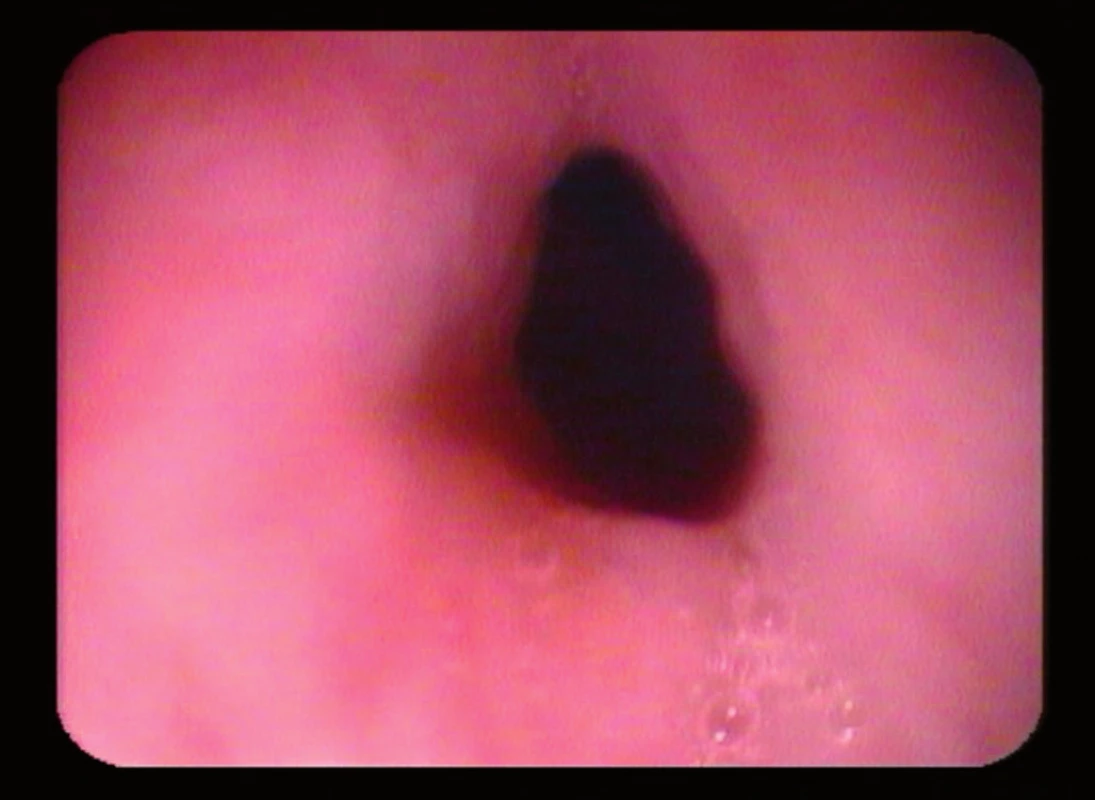 Ezofagoskopické vyšetrenie – primerane veľký lúmen v mieste Kilianovho zvierača.
Fig. 2. Esophagographic examination – average size of lumen in the region of Killian sphincter.