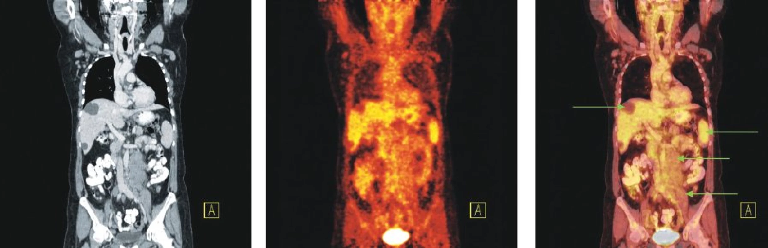 Snímky výpočetní tomografie (CT), pozitronové emisní tomografie (PET) a PET/CT u nemocné s nově zjištěnou diagnózou chronické Blymfocytární leukemie a genetickou abnormalitou 11q-. Na CT lze diferencovat zvětšené lymfatické uzliny na krku a v tříslech, paraaortálně vlevo pod odstupem renální tepny jsou až pakety uzlin. Žádná z uvedených lymfatických uzlin ani uzlinové pakety nevykazují zvýšenou konzumpci glukózy. Tři hypodenzní ložiska charakteru cyst v játrech. Relativně vyšší akumulace FDG v nezvětšené slezině.