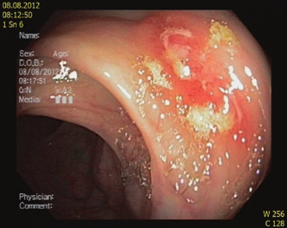 Endoskopický obraz: A – vřed terminálního ilea, B – vřed v tračníku.
Fig. 2. Endoscopic images: A – ulcer of terminal ileum, B – ulcer of colon.