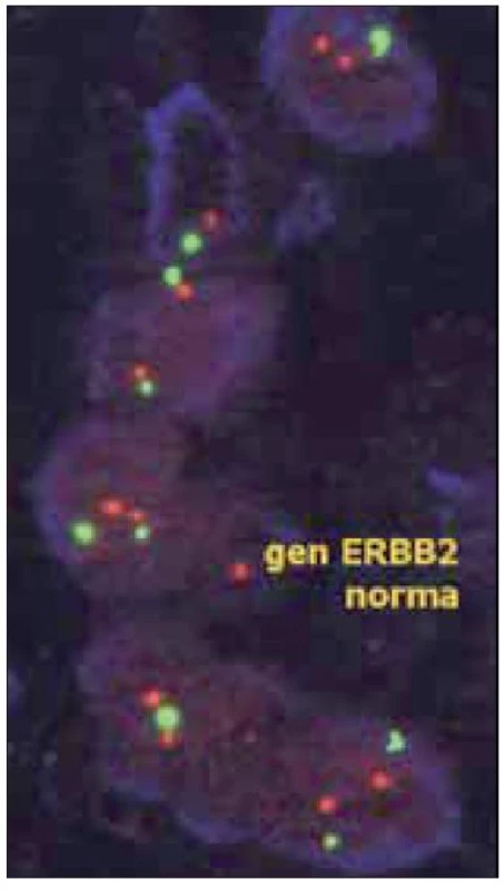 Při vyšetření amplifikace genu HER2 pomocí FISH slouží centromerická oblast 17. chromozomu jako referenční hodnota počtu chromozomů. Pokud není amplifikace přítomna, nepřevyšuje počet signálů HER2 (červené) v jednotlivých buňkách počet centromerických signálů (zelené) více než 1,8krát. (dle www.patologie.info.cz