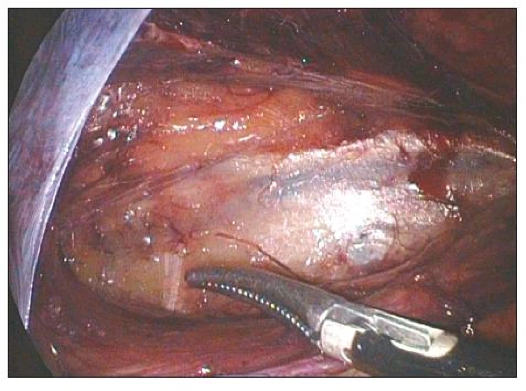 TAPP levého třísla. Špička disektoru ukazuje na n. cutaneus femoris lateralis
Fig. 1. TAPP of the left groin. The dissector tip points at n. cutaneus femoris lateralis