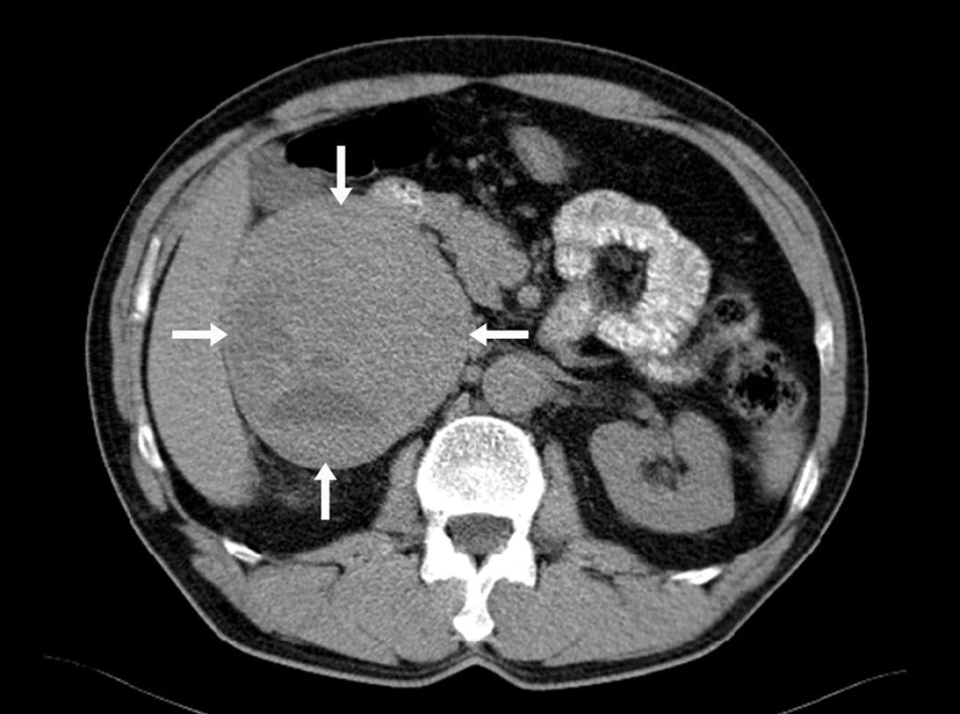 CT obraz feochromocytomu pravé nadledviny indikované primárně k laparotomické adrenalektomii
Fig. 1: CT image of a right kidney feochromocytoma indicated for laparoscopic adrenalectomy
