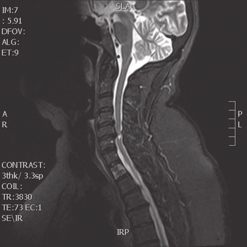 MRI krční páteře, sagitální, T2-vážený sken (Žena, 56 let, stenóza páteřního kanálu 6,0 mm a myelopatické změny míchy na etáži C5/6, před operací.)
Fig. 3: cervical spine MRI, T2-weighted sagittal scan (Female patient, 56-year-old, stenosis of the spinal canal of 6.0 mm and myelopathic changes at level C5/6, before surgery)