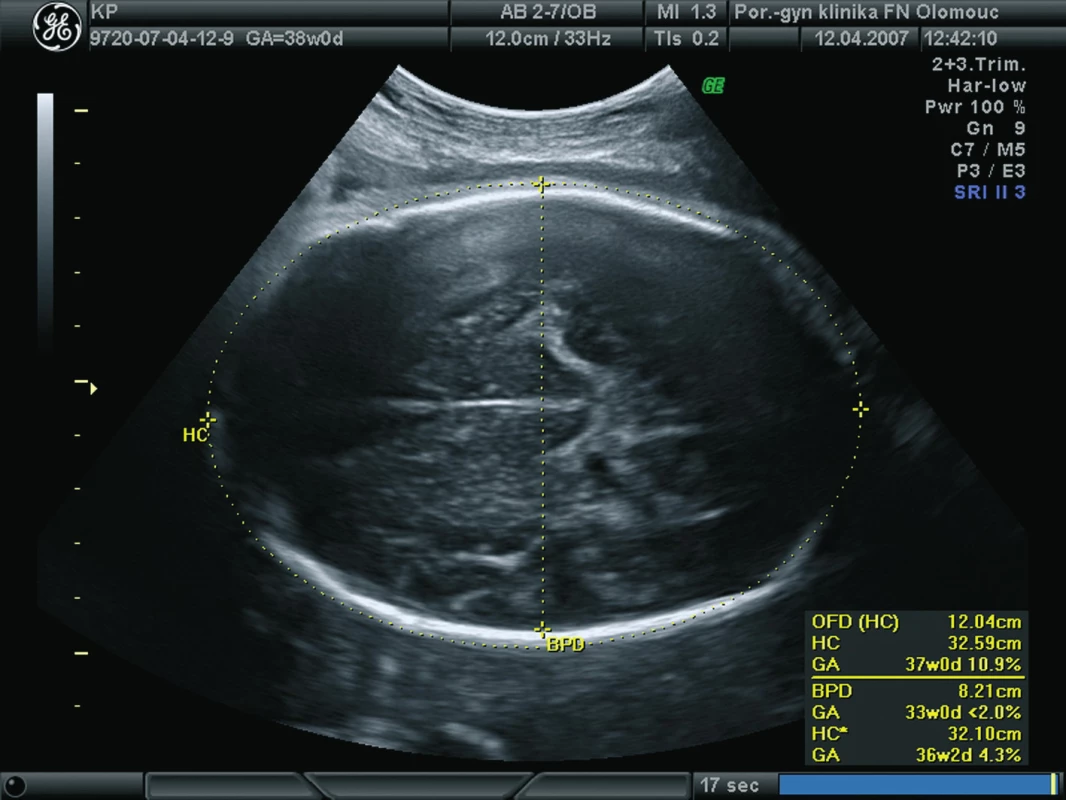 „Breech Head“ ultrazvukový obraz ve 37. týdnu těhotenství (HC – obvod hlavičky – 326 mm – 37+0, BPD – biparietální průměr – 82 mm – 33+0, OFD – okcipitofrontání průměr – 120 mm, poměr okcipitofrontálního a biparietálního průměru (OFD/BPD ratio) = 1,46).