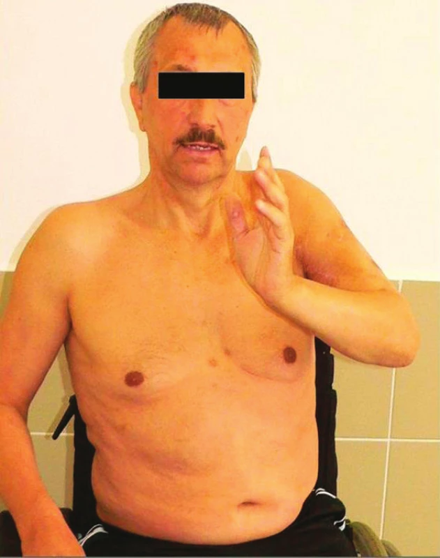 Funkční snímek pacienta po provedení artrodézy ramene
Fig. 3: Functional range of a patient treated by shoulder arthrodesis