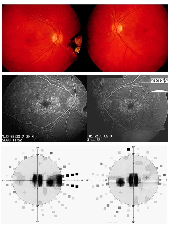 Fundus flavimaculatus projevující se jako zadní uveitida obou očí u 33leté pacientky. Koincidence s toxoplazmovou chorioretinitidou pravého oka. A) Žlutobělavá drobná ložiska na úrovni retinálního pigmentového epitelu obou očí. Na očním pozadí pravého oka patrná pigmentovaná chorioretinální jizva. B) Fluorescenční angiografie ukazuje hyperfluorescenci drobných ložisek na sítnici obou očí, nedochází však k patologickému prosakování fluoresceinu. C) Vyšetření zorného pole odhalilo centrální skotomna obou očích a další skotom v temporální periferii pravého oka korespondující s ložiskem, které se nachází nazálně od papilyzrakového nervu