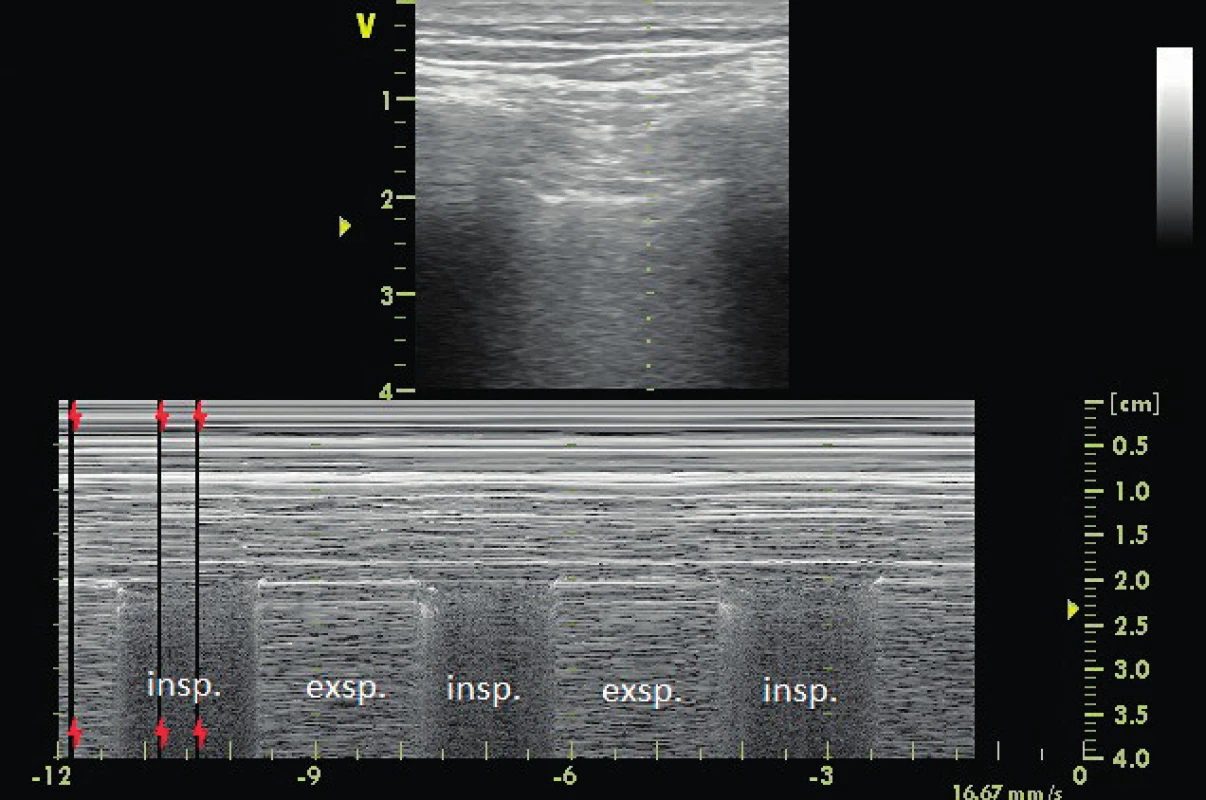 Lung point v přední axilární čáře potvrzující diagnózu okultního ventrálního pneumotoraxu