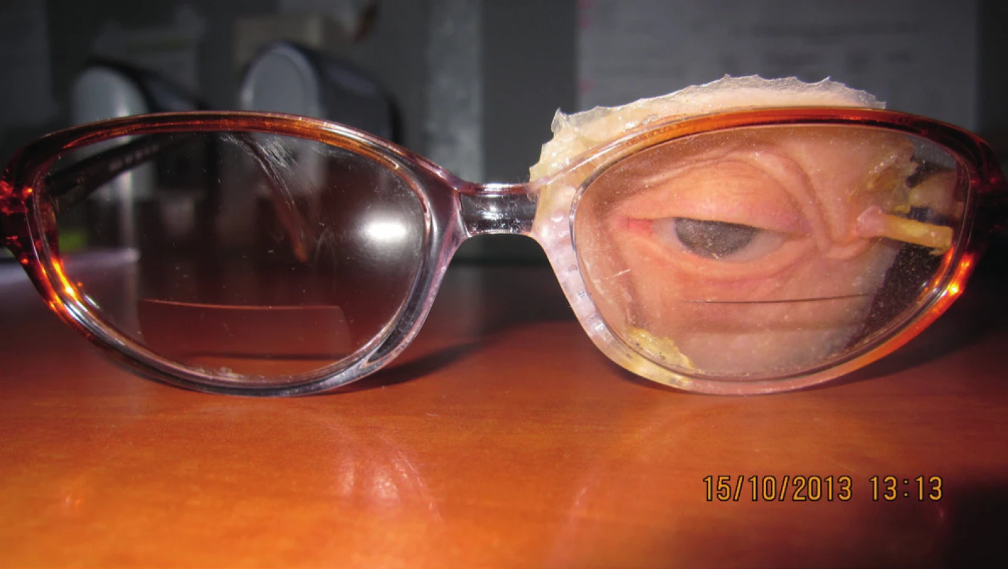Detail epitézy na ráme okuliarov, pohľad spredu
