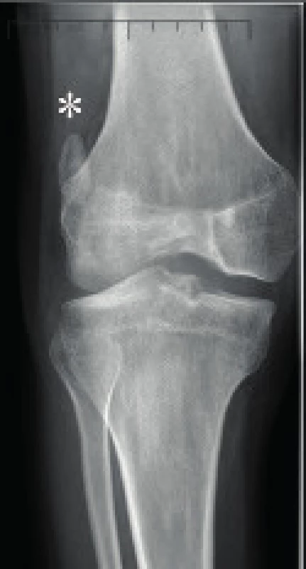 RTG snímek pacienta s nail-patella syndromem – značka určuje laterální pozici hypoplastické pately.
Fig. 5. X-ray of patient with nail-patella syndrome – lateral position of hypoplastic patella marked