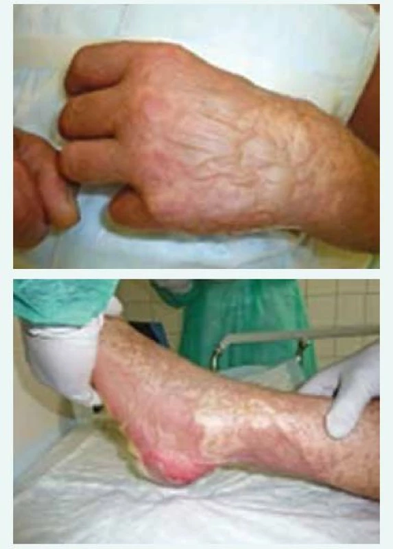 a obr. 3. Splývající buly a počínající epidermolýza levé ruky a nohy vstupně.
