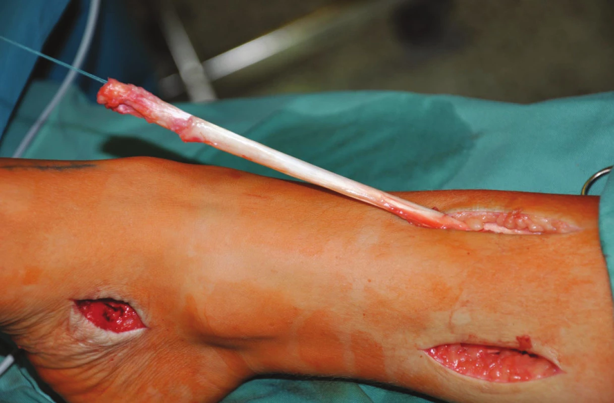 Šlacha m. tibialis posterior po protažení přes interoseální membránu na ventrální stranu bérce
Fig. 2: The posterior tibila tendon inserted through membrana interossea cruris onto the ventral side of the shank