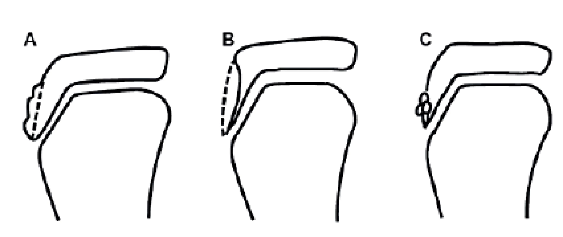 Závažnost OS dle RTG nálezu: A) změna nebo lehká elevace tuberositas tibiae;  
B) radiolucence tuberositas tibiae; C) fragmentace tuberositas tibiae (8).