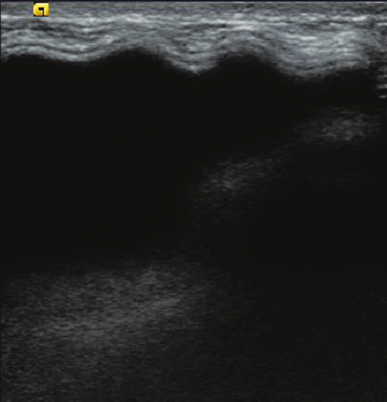 USG – zvlněný implantát vlevo
Fig. 1: USG – Undulation of left breast silicone implant