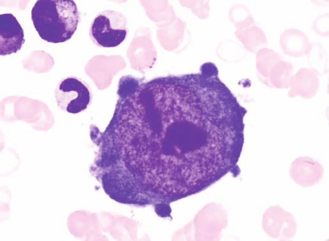 Obrovský proerytroblast v kostní dřeni typický pro infekci parvovirem B19 u pacienta č. 2.
Fig. 3. Giant proerythroblasts in the bone marrow, typical for infection caused by parvovirus B19 in the patient No. 2.