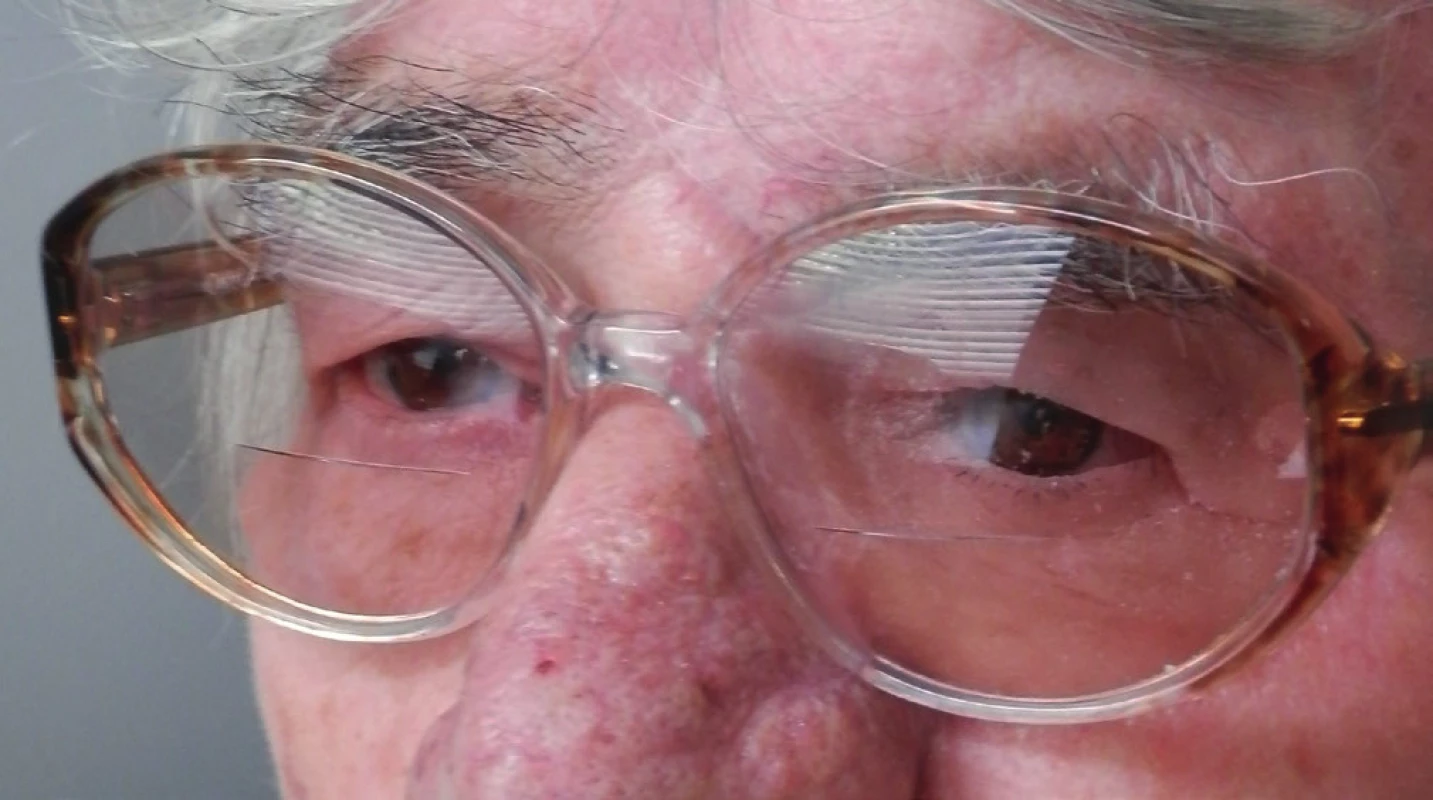 Pacientka s epitéziou ľavej očnice na ráme okuliarov nasadenou na tvár