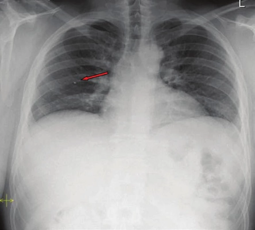 Kontrolní RTG hrudníku po roce: hyperdenzní struktura v oblasti pravého plicního pole
Fig. 3 : Check-up chest X-ray after one year period: hyperdense structure in the area located of the right pulmonary field