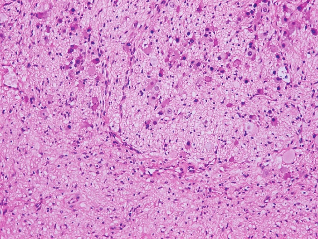 Histologické zobrazení ganglioneuromu barvené hematoxylin eozinem, zvětšeno 200x.