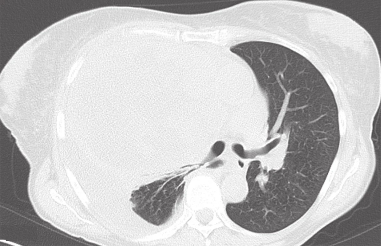 CT plic kazuistika 3
Fig. 3: Thoracic CT scan, case report 3