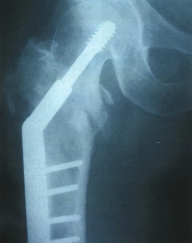 Pertrochanterická zlomenina stehenní kosti z obrázku 3 léčena osteosyntézou
Fig. 4. The pertrochanteric femoral fracture depicted on Fig. 3, managed by osteosynthesis