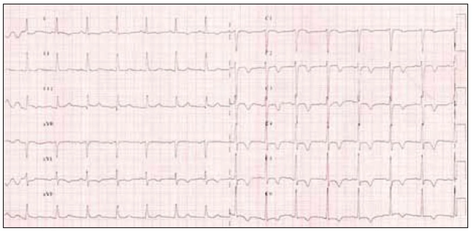 12svodové EKG po ukončení hyperventilačního testu.