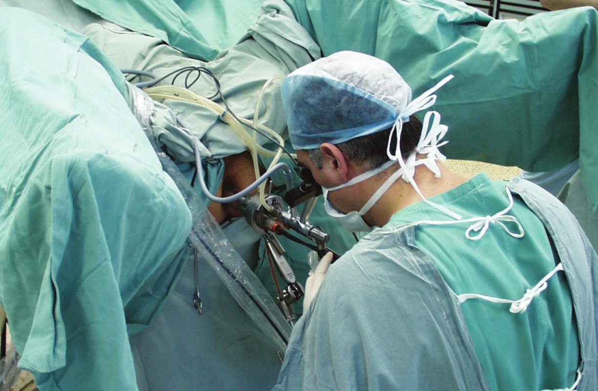 Práce chirurga s operačním rektoskopem
Fig. 3. Surgeon’s work with operating rectoscope