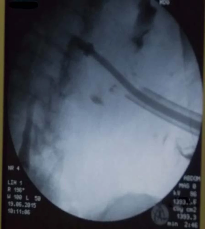Skiaskopická kontrola správného uložení rentgen kontrastního prstence proximálního konce stentu v ledvině
Fig. 1. Radiograph of good location of a radio-opaque ring marker on the proximal end of the stent in the kidney