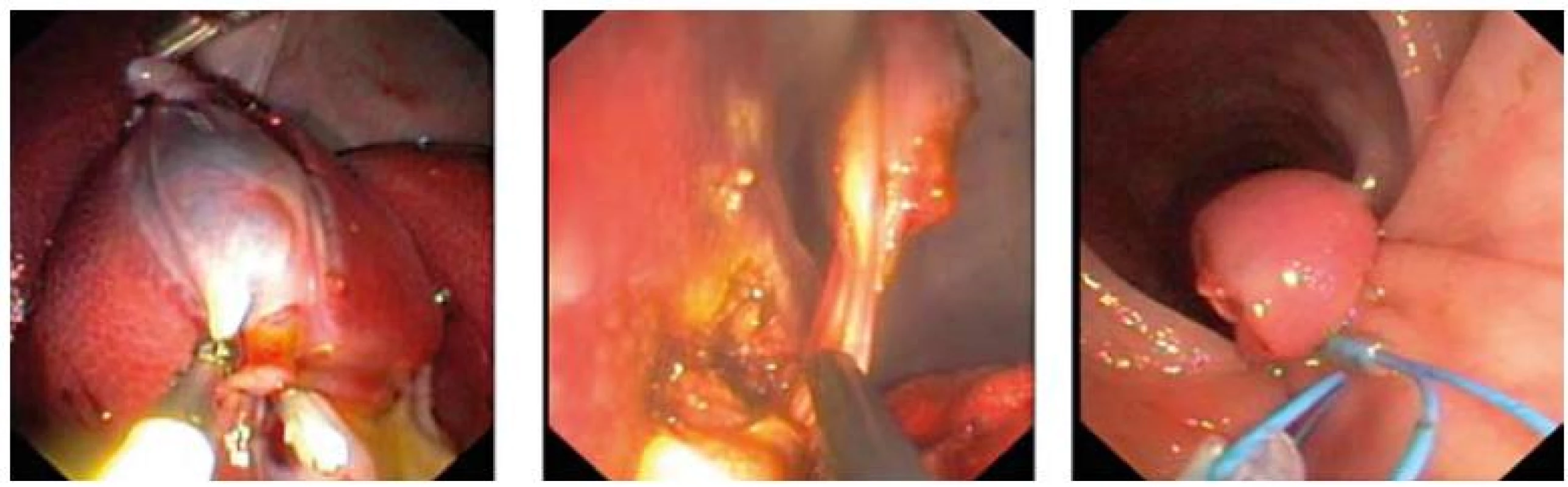 Transrektální hybridní cholecystektomie (klipování a. cystica, disekce z lůžka žlučníku, uzávěr rekta typu loop-and-clip).
Fig. 1. Transrectal hybrid cholecystectomy (clipping of the cystic artery, gallbladder dissection, rectal loop-and-clip closure).
