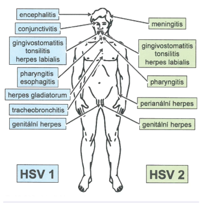 Schéma jednotlivých možných onemocnění vyvolaných HSV-1 a HSV-2
Fig. 2. Diseases caused by HSV-1 and HSV-2