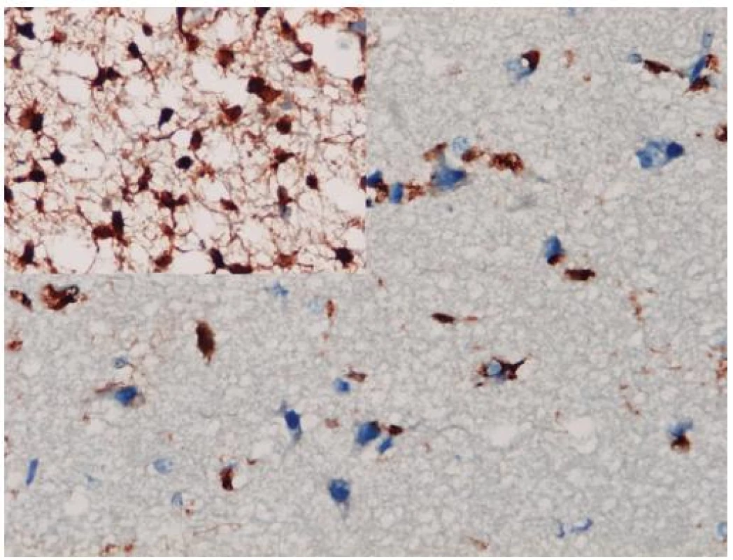 Imunohistochemické farbenie mutantného proteínu IDH1. Aj v infitrujúcom okraji difúzneho astrocytómu, kde je obtiažne diagnostikovať glióm na základe histomorfológie, je možné zobraziť izolované nádorové astrocyty (vložený detail je z centrálnej časti toho istého tumoru). Imunohistochémia IDH1, x 400.