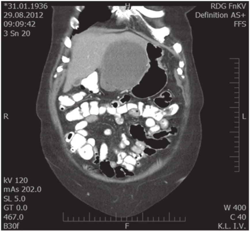 Koronární MDCT scan, útlak žaludku a L jaterního laloku
Fig. 2. Coronal MDCT scan, compression of the stomach and left liver lobe