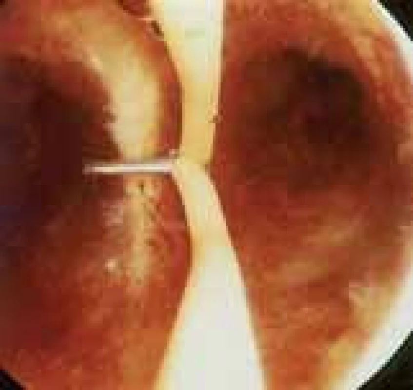 Hysteroskopické odstranění děložního septa.