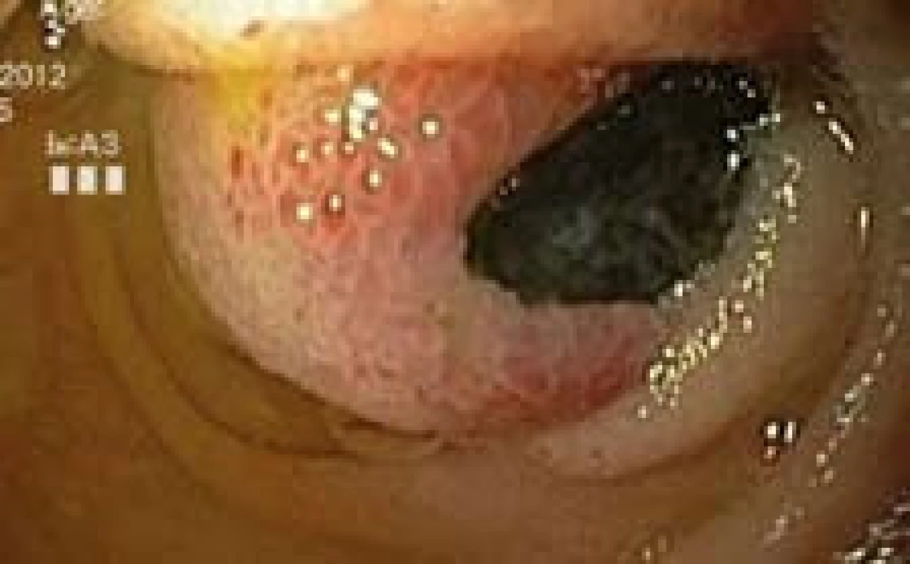 Exulcerovaný polyp jejuna, push enteroskopie.
Fig. 1. Ulcerated poylp of jejunum, push enteroscopy.