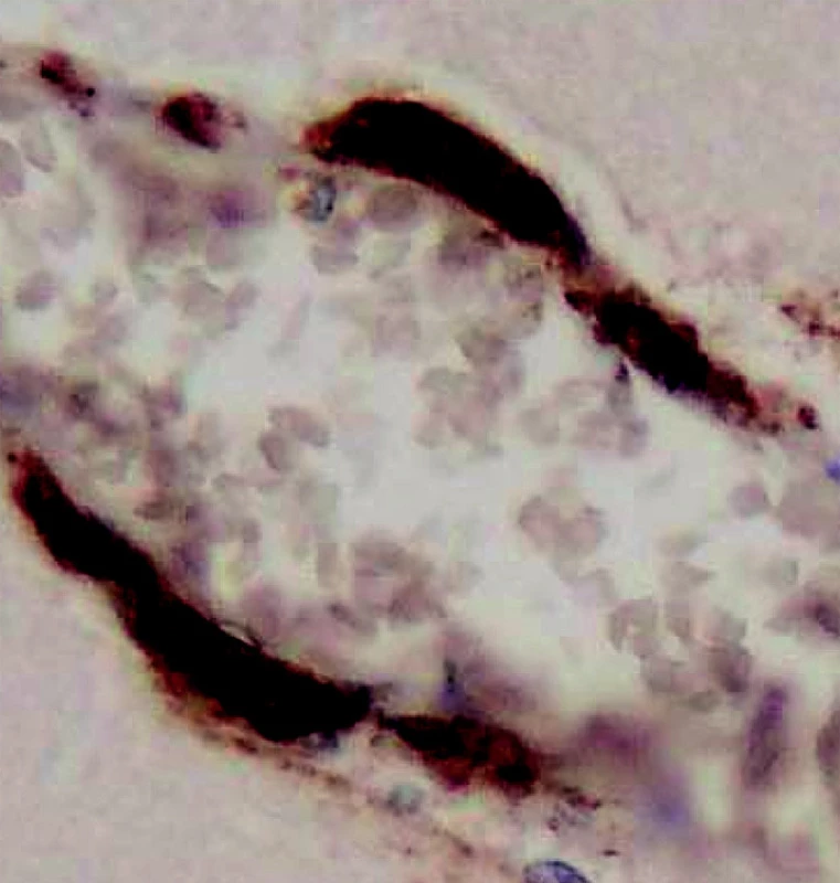 Mozková amyloidová angiopatie. Imunohistochemická reakce prozrazující bamyloid. (Zv. x 400, barveno protilátkou proti b-amyloidu).