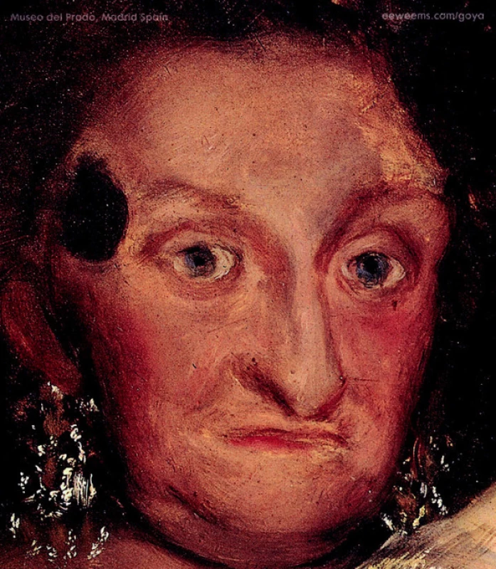 Infantka María Josepha s kožným a očnými prejavmi (detail obr. 1 a 2).