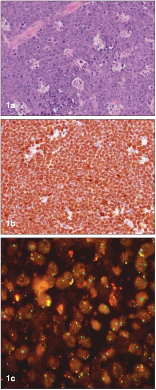 Histopatologická diagnostika Burkittova lymfomu (materiál Interní hematoonkologické kliniky, zpracoval L. Křen, Ústav patologie FNB): (a) základní barvení hematoxylinem-eosinem, (b) imunohistochemický průkaz proliferačního faktoru Ki-67, (c) fluorescentní in situ hybridizace (FISH) – pozitivní translokace (8;14).